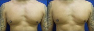 KB-gynecomastia-surgery-nyc-before-after-LB-1-1