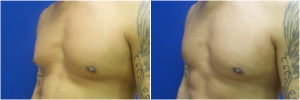 KB-gynecomastia-surgery-nyc-before-after-LB-1-2