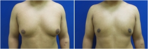 KB-gynecomastia-surgery-nyc-before-after-MP-1-1