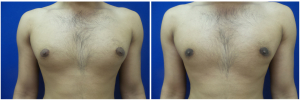 MR-gynecomastia-surgery-nyc-before-after-photo-1-1