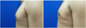 MR-gynecomastia-surgery-nyc-before-after-photo-1-3