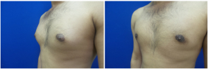 MR-gynecomastia-surgery-nyc-before-after-photo-1-4