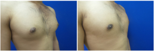 MR-gynecomastia-surgery-nyc-before-after-photo-1-5