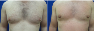 MV-gynecomastia-surgery-nyc-before-after-photo-1-1