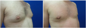 MV-gynecomastia-surgery-nyc-before-after-photo-1-3