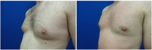 MV-gynecomastia-surgery-nyc-before-after-photo-1-4