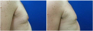 MV-gynecomastia-surgery-nyc-before-after-photo-1-5