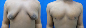 gynecomastia-plastic-surgery-nyc-before-after-1