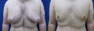 gynecomastia-plastic-surgery-nyc-before-after-11