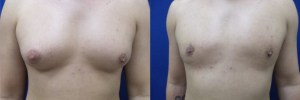 gynecomastia-plastic-surgery-nyc-before-after-12