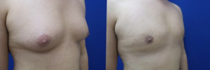 gynecomastia-plastic-surgery-nyc-before-after-13