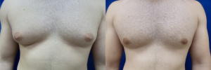 gynecomastia-plastic-surgery-nyc-before-after-14