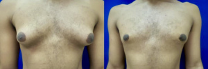 gynecomastia-plastic-surgery-nyc-before-after-16