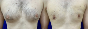 gynecomastia-plastic-surgery-nyc-before-after-17