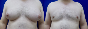 gynecomastia-plastic-surgery-nyc-before-after-18