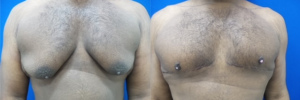 gynecomastia-plastic-surgery-nyc-before-after-19