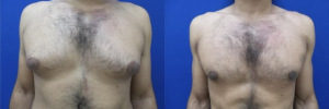 gynecomastia-plastic-surgery-nyc-before-after-2