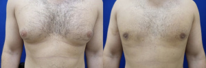 gynecomastia-plastic-surgery-nyc-before-after-4