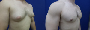 gynecomastia-plastic-surgery-nyc-before-after-5