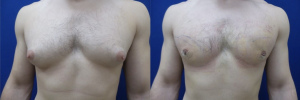gynecomastia-plastic-surgery-nyc-before-after-6