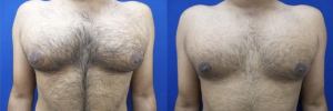 gynecomastia-plastic-surgery-nyc-before-after-7