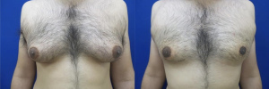 gynecomastia-plastic-surgery-nyc-before-after-8