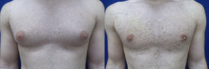 gynecomastia-plastic-surgery-nyc-before-after-9