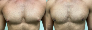 gynecomastia-surgery-nyc-before-after-photo-19