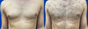 gynecomastia-surgery-nyc-before-after-photo-20