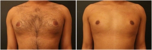 gynecomastia-surgery-nyc-before-and-after1-1