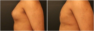 gynecomastia-surgery-nyc-before-and-after1-2