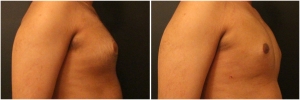 gynecomastia-surgery-nyc-before-and-after1-3