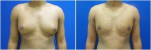 gynecomastia-surgery-nyc-before-and-after2-1