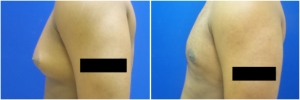 gynecomastia-surgery-nyc-before-and-after2-2