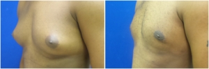 gynecomastia-surgery-nyc-before-and-after2-3