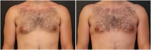 gynecomastia-surgery-nyc-before-and-after3-1