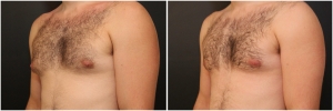 gynecomastia-surgery-nyc-before-and-after3-2