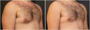 gynecomastia-surgery-nyc-before-and-after3-3