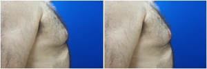 gynecomastia-surgery-nyc-before-and-after4-1