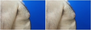 gynecomastia-surgery-nyc-before-and-after4-1