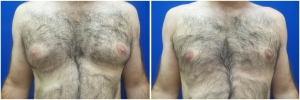 gynecomastia-surgery-nyc-before-and-after4-2