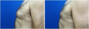 gynecomastia-surgery-nyc-before-and-after4-3