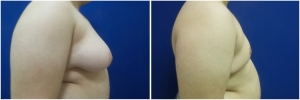 gynecomastia-surgery-nyc-before-and-after6-1