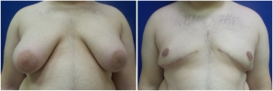 gynecomastia-surgery-nyc-before-and-after6-2